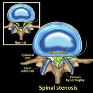 Ligamentum Flavum Hypertrophy | Definition, Cause And Treatment