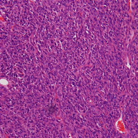 Solitary Fibrous Tumor Histology