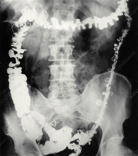 Barium X-ray showing colonic diverticula - Stock Image M140/0083 - Science Photo Library