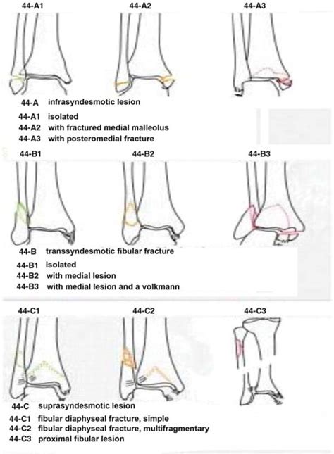 Types Of Fibular Fractures