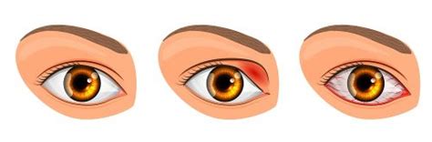 Viral Eye Infection: Types, Symptoms, Treatment | STD.GOV Blog