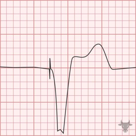 Paced Rhythms | ECG Stampede