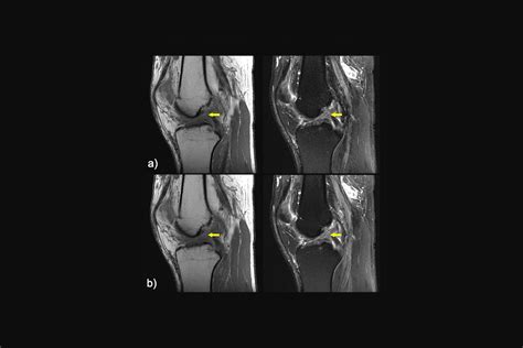 Artificial Intelligence Reconstructs Missing Data from Rapid MRI Scans | Welcome AI Insights