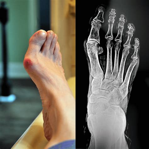 BUNION – SYMPTOMS, DIAGNOSIS AND TREATMENT - Health & Dsease