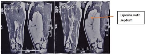 Lipoma Ultrasound Treatment - Infoupdate.org