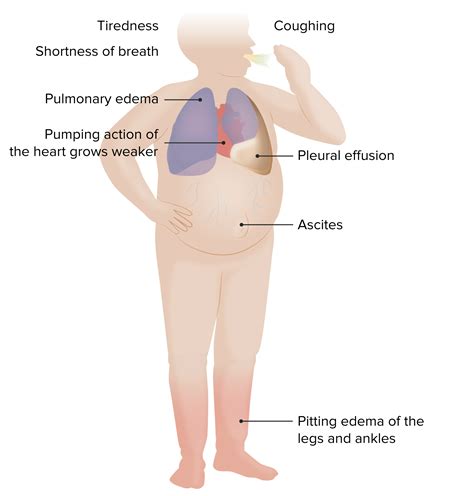 Which of the Following Statements Best Describes Heart Failure ...