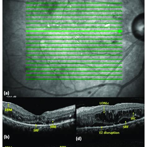 OCT biomarkers in diabetic macular edema (DME) eyes. (a) A ...