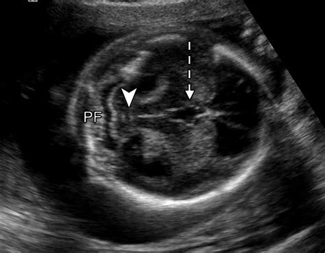 Fetal Brain Ultrasound Images