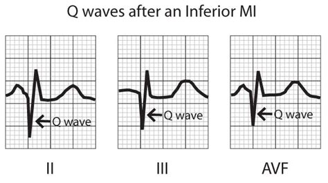 Ecg Signs Of Myocardial Infarction: Pathological Q-waves & Pathological 436