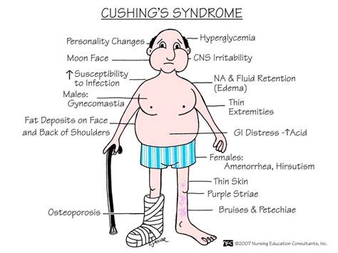 ABC Medicine: Cushing's Syndrome | Nursing school | Pinterest | Cushing's syndrome, Medicine and ...