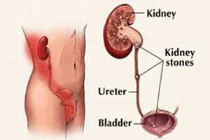 Kidney Stones | Urology Health Solutions