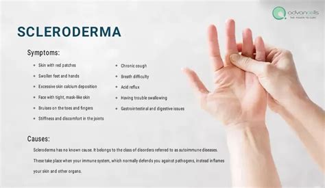 Scleroderma Symptoms, Types, and Available Treatment - Social Social Social | Social Social Social