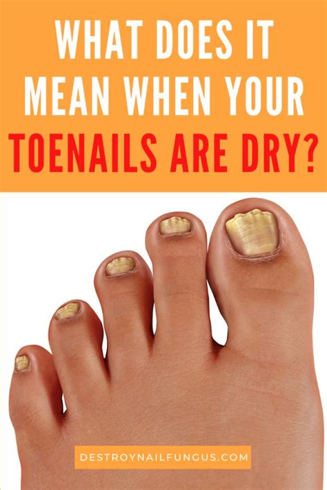 How To Treat Dry Toenails in 2020 | Toenail fungus, Toe nails, Toenail ...