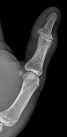 Psoriatic arthritis | Radiology Case | Radiopaedia.org