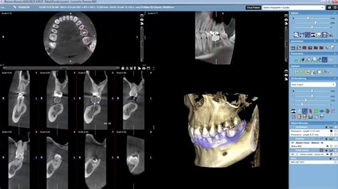 Planmeca Romexis 3D Implant Planning with open STL and crown library ...