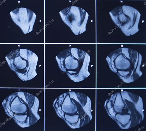 Meniscus Tear Knee Mri | lupon.gov.ph