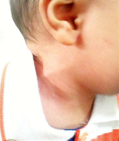 Fibromatosis Colli, a Rare Cause of Neck Mass in Infants: A Case Report | Journal of Case ...