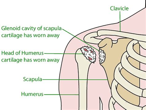 Glenohumeral arthritis causes, symptoms, diagnosis & treatment