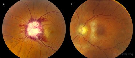 Atlas Entry - Ocular Syphilis Presenting with Posterior Subcapsular Cataract