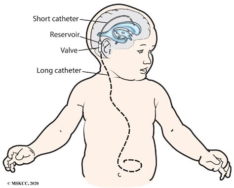 How Does A Vp Ventriculoperitoneal Shunt Work Fort