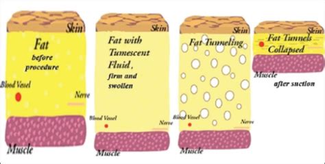 Tumescent Liposuction - OpenAnesthesia