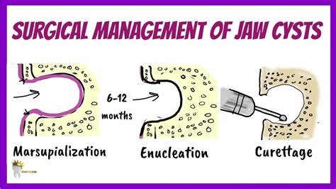 ORAL SURGERY | ENUCLEATION AFTER MARSUPIALIZATION - YouTube