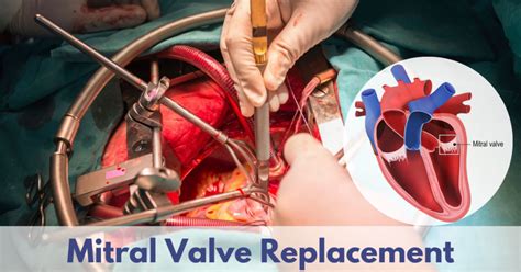 What Symptoms Indicate the Need for Mitral Valve Replacement? | Sri Ramakrishna Hospital