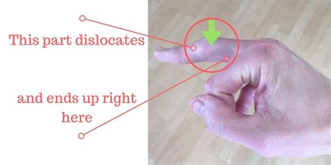 How To Fix A Dislocated Finger Knuckle