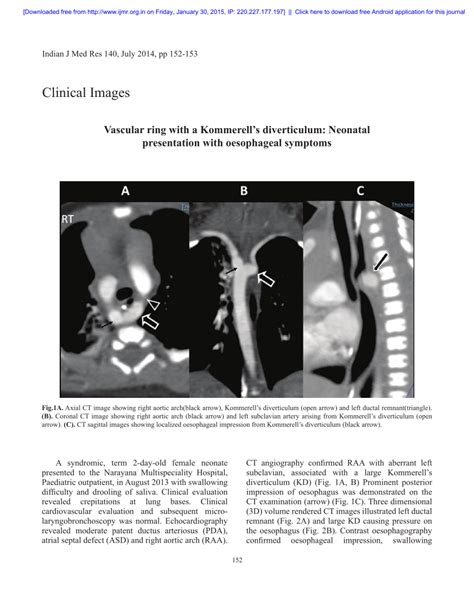 (PDF) Vascular ring with a Kommerell’s diverticulum: Neonatal ...