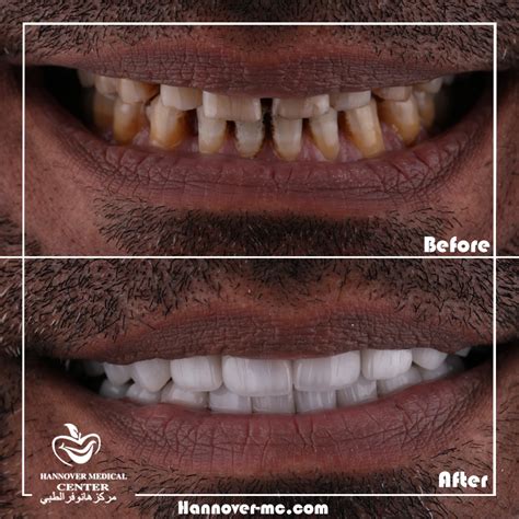 Resin Veneers vs Porcelain: What’s the Difference? - Hannover Medical Center Sharjah