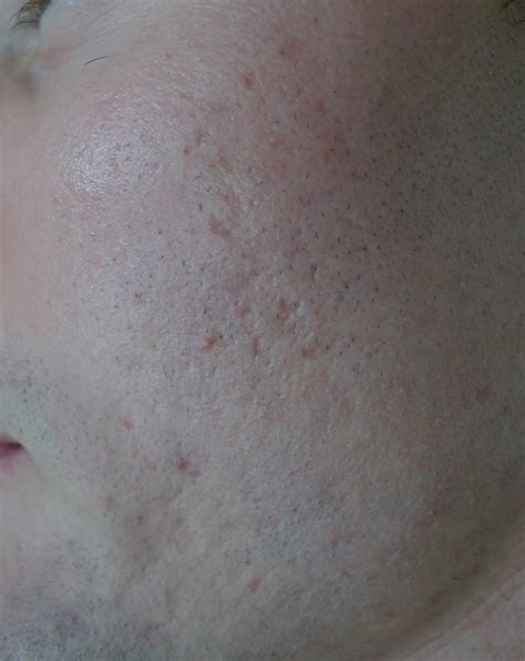 ACD A-Z of Skin - Acne Scars (Acne Scarring)