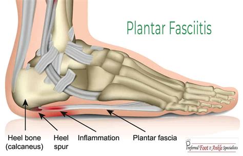 Our company Whirlpool overthrow pain bottom of heel and ankle hot ...