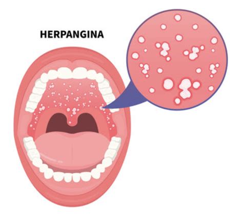 Herpangina in Adults: Symptoms, Causes, and Effective Treatments