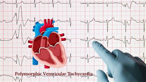 Polymorphic Ventricular Tachycardia - Meaning, Types, Causes, Symptoms, Prevention & Treatment ...