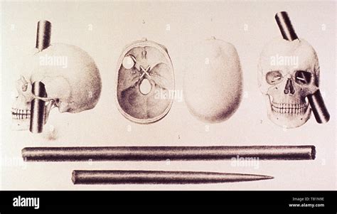 Phineas gage skull hi-res stock photography and images - Alamy