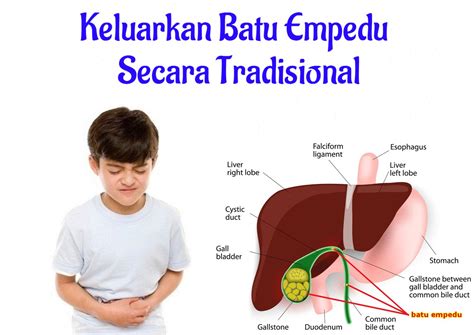 Keluarkan Batu Empedu Tanpa Operasi