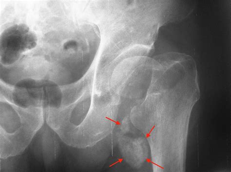 MedView Medical Imaging Consultancy Info Page: Calcific bursitis