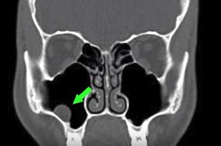 Abnormal Sinus Ct Scan