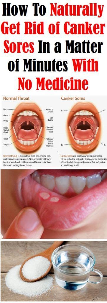 HOW TO NATURALLY GET RID OF CANKER SORES IN MINUTES WITH NO MEDICINE | Canker sore, Canker sore ...