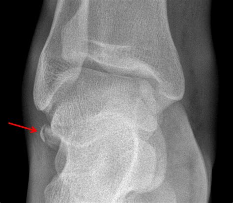 Dorsal Talar Avulsion Fracture