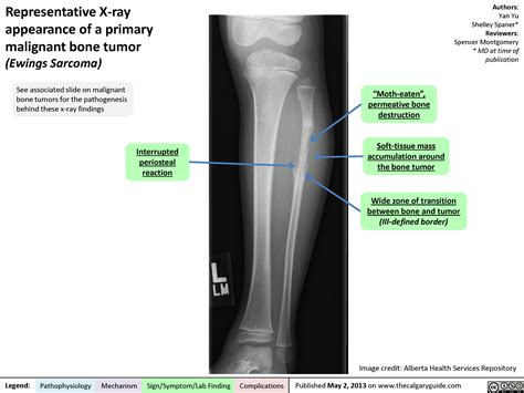 Representative X-ray appearance of a primary malignant bone tumor | Calgary Guide