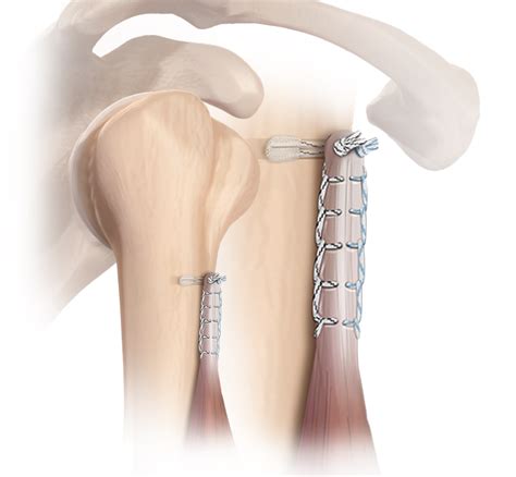 Arthrex - FiberTak® Biceps Tenodesis Technique