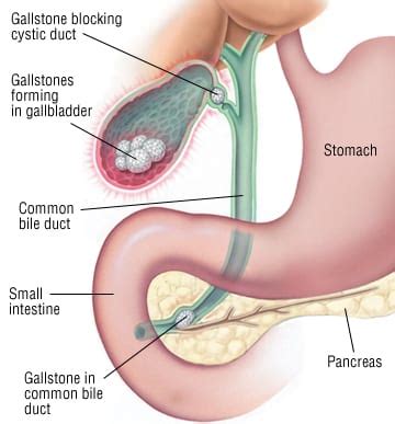 Futibatinib for FGFR2 Mutated Intrahepatic Cholangiocarcinoma | 2 Minute Medicine