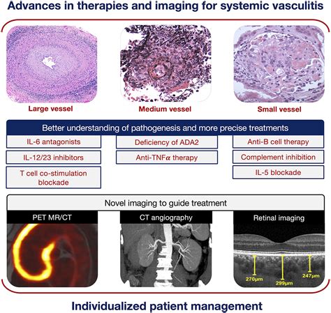 Vasculitis Classification