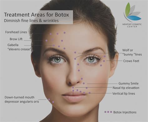 Facial Diagram Botox Injection Sites ... | Botox injection sites, Botox, Botox injections