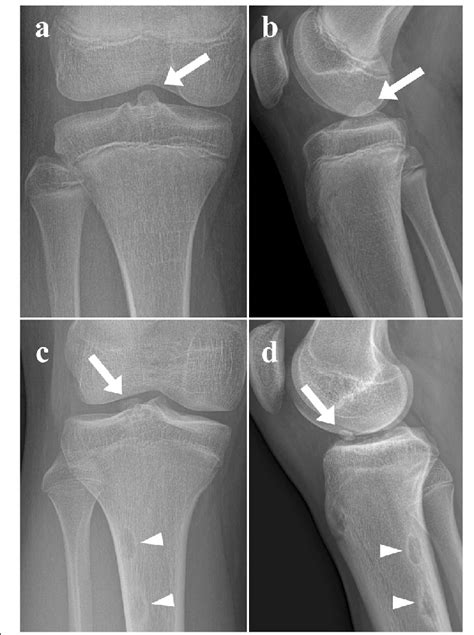 Tibial Intercondylar Eminence