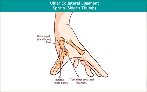 Thumb Ulnar Collateral Ligament Injury | Melbourne Hand Therapy