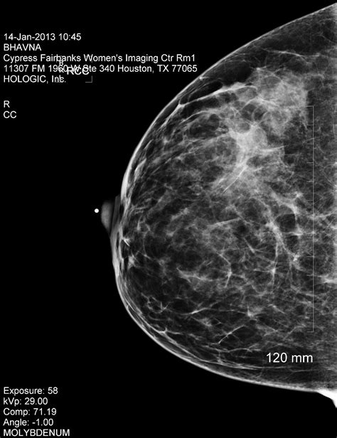 Cancer Chronicles: Mammogram and Ultrasound