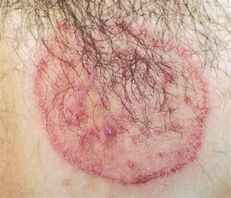 Dermatophytes that causes Cutaneous mycoses in humans and How to deal with it. | HubPages