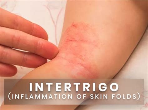 Intertrigo (Inflammation Of Skin Folds): Causes, Symptoms, Risk Factors, Treatments And ...